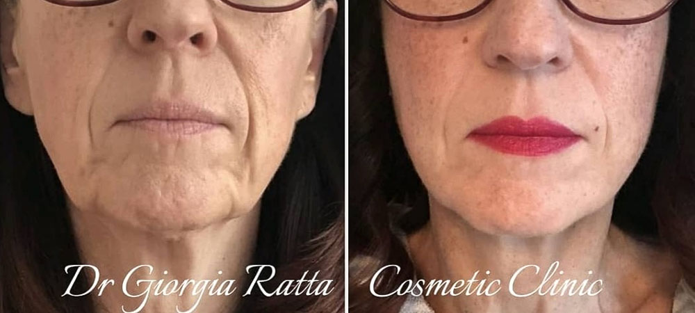 Non surgical Face Lift Treatments -before and after