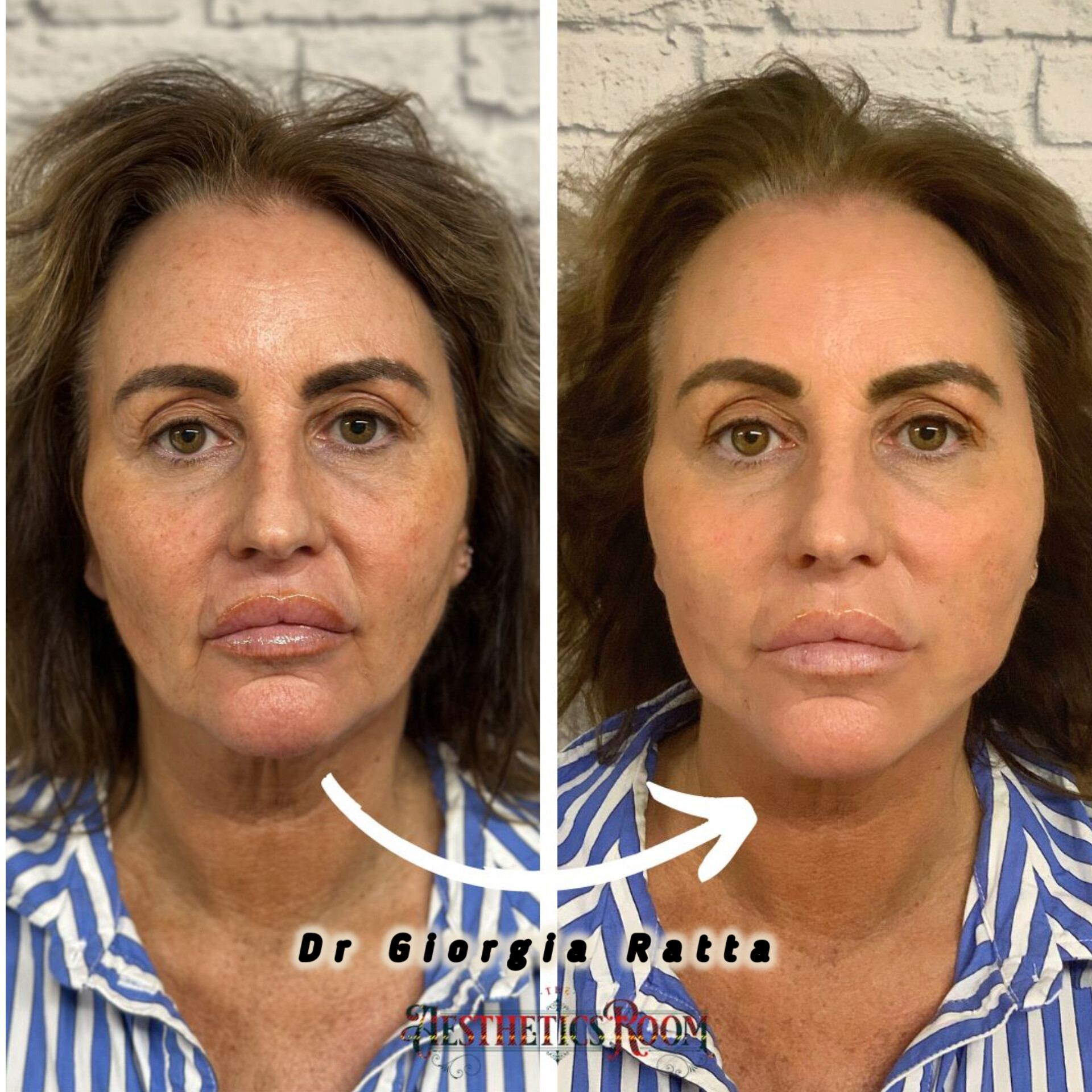 Dr Giorgia Ratta - Generation Aesthetics Clinics - Spring Thread Lift