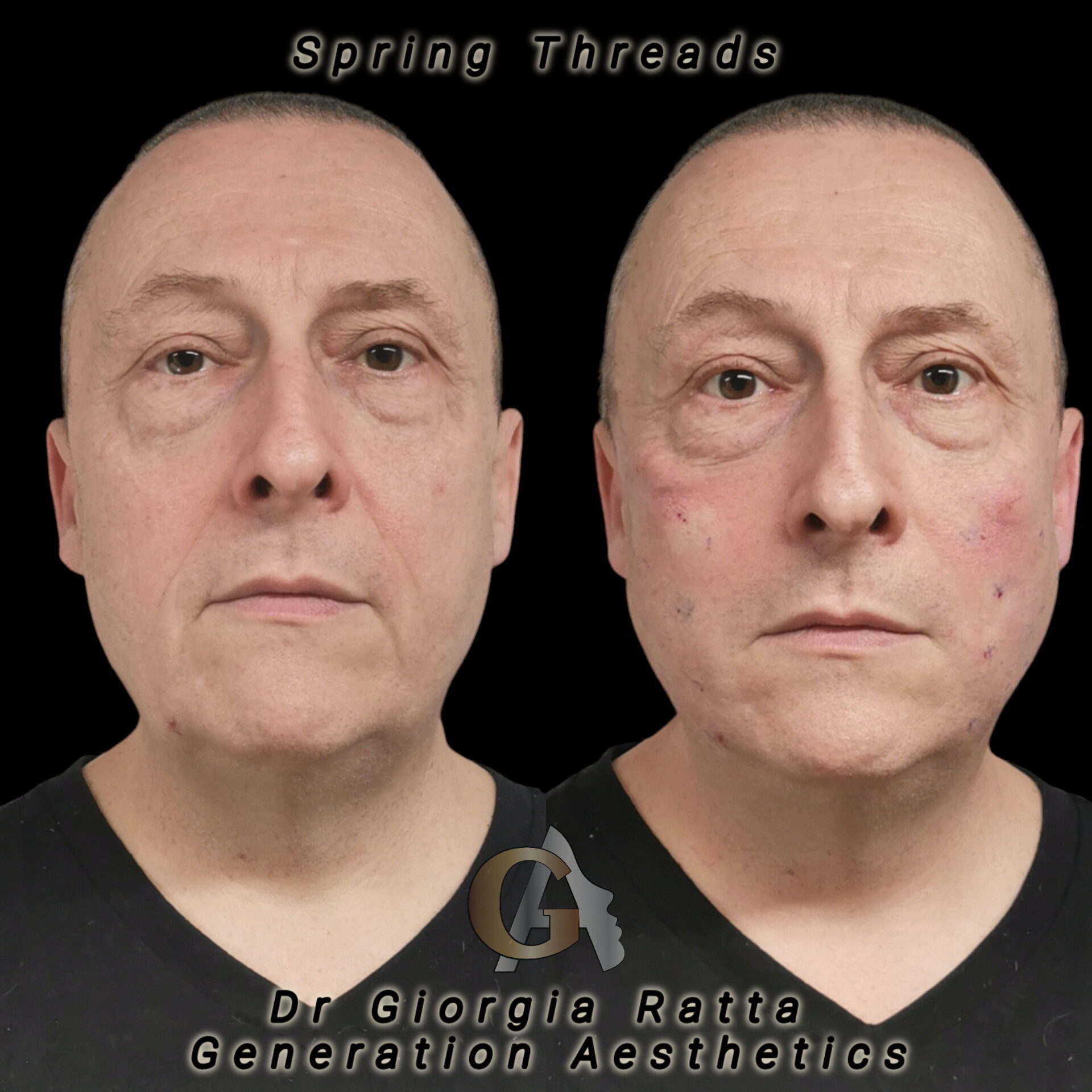 Dr Giorgia Ratta - Generation Aesthetics Clinics - Spring Thread Lift