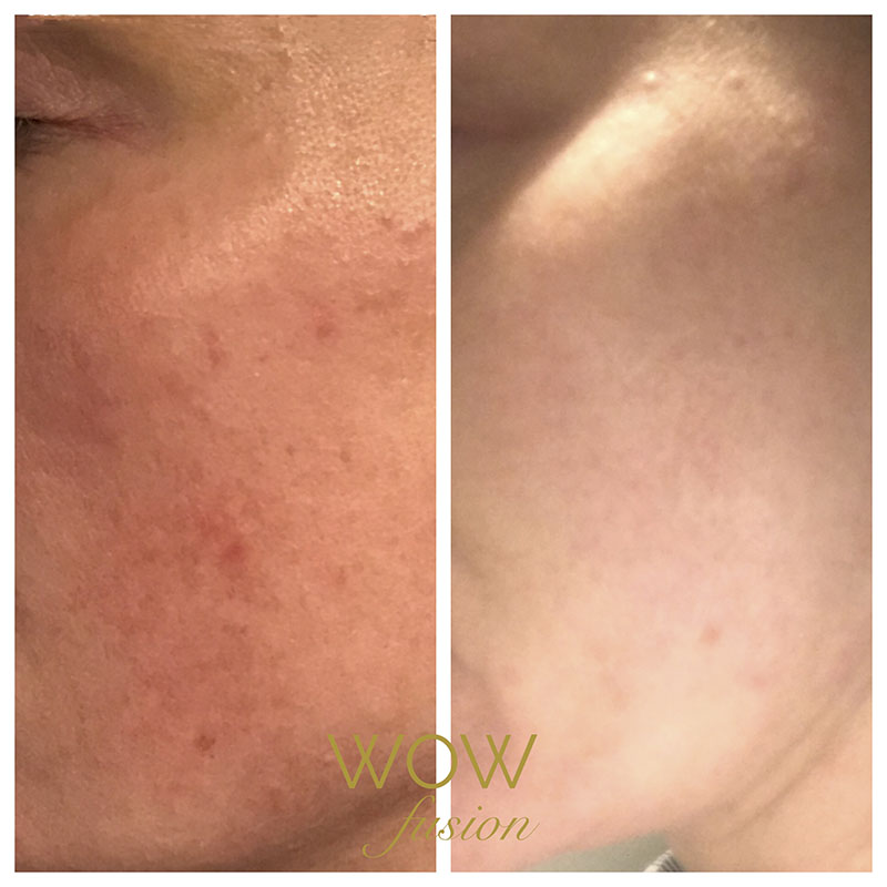 WOW Fusion® can be used to treat the following skin concerns