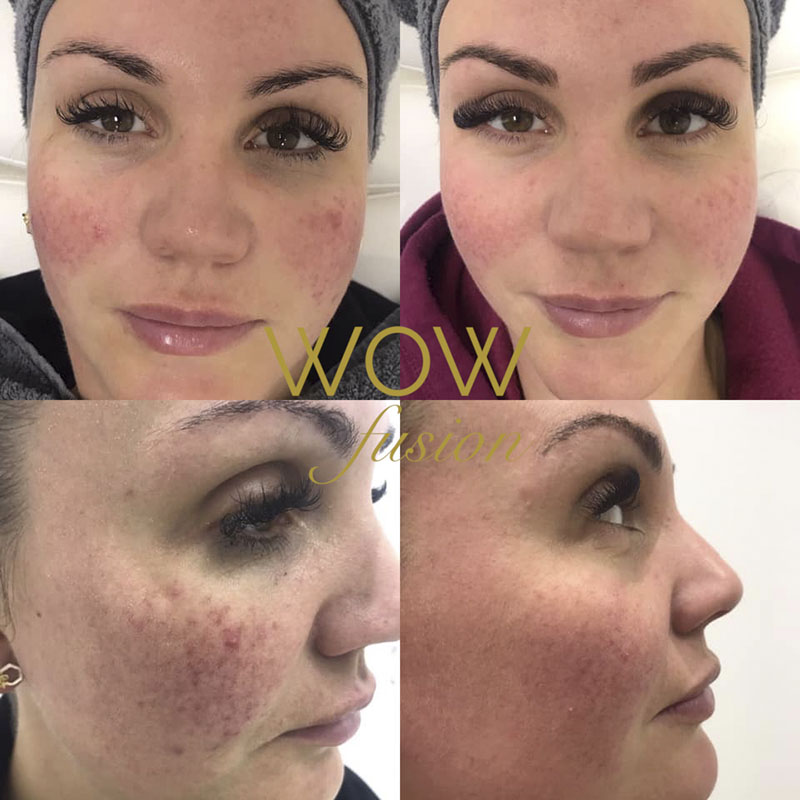 WOW Fusion® can be used to treat the following skin concerns